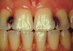 tooth-color-filling