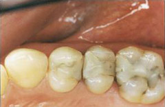 tooth-color-filling 02-02-before