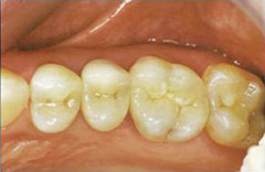 tooth-color-filling 02-02-after