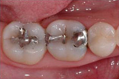tooth-color-filling/02-03-before