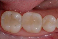 tooth-color-filling/02-03-after