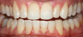 tooth-color-filling 02-04-after.jpg