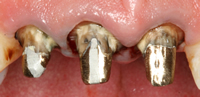 prosthodontics clip