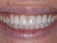 aesthetic-dentistry 5-after