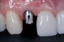 prosthodontics clip